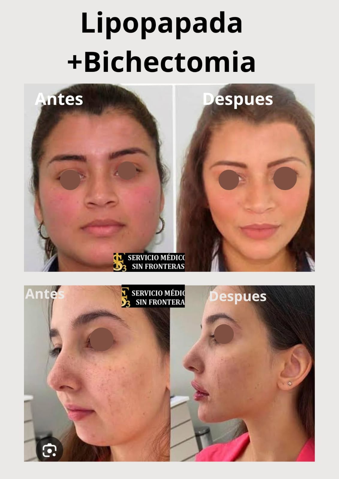 Bichectomía Lipopapada